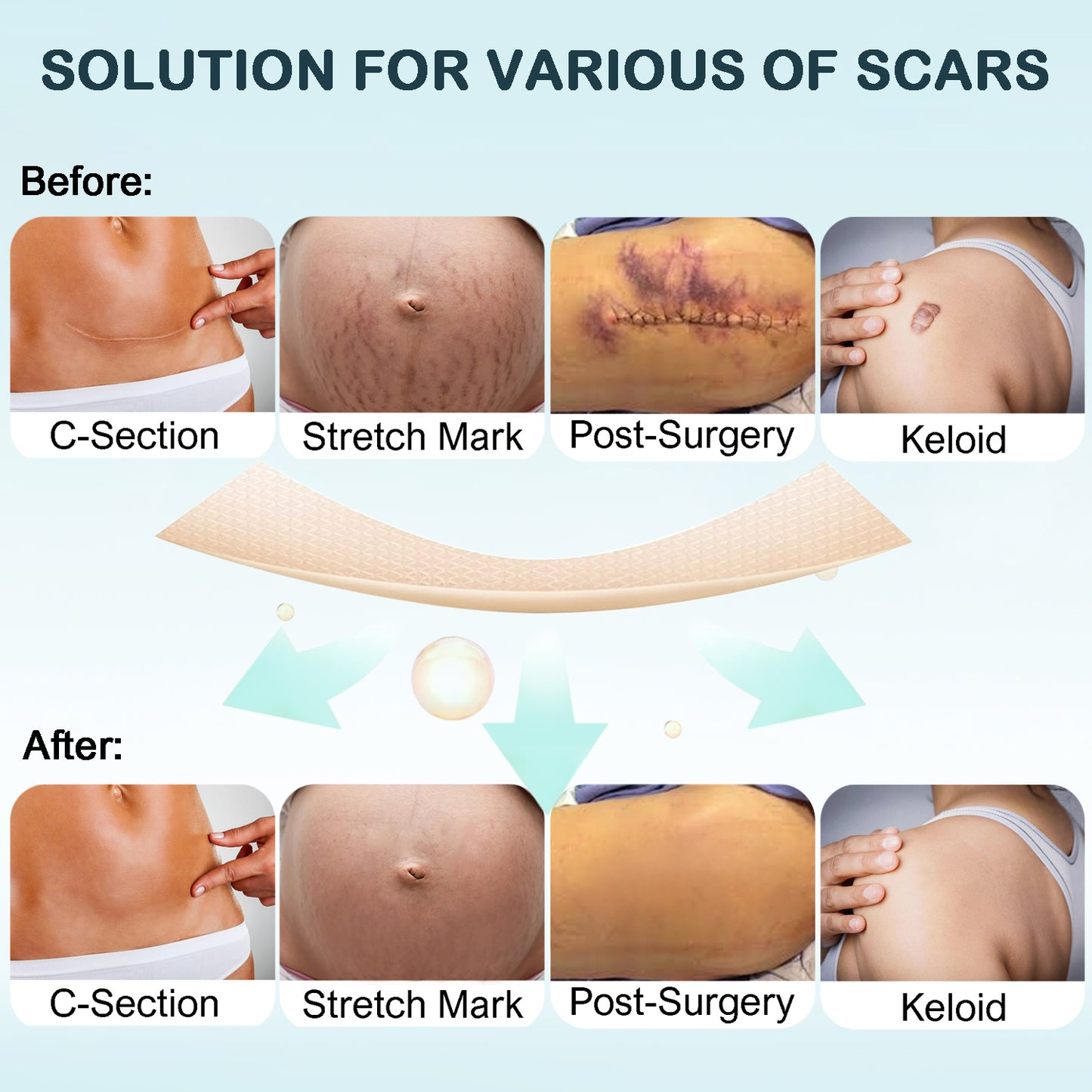 12 pcs Silicone Scar Patch 12 PCS , Silicone Scar Sheet for Stretch Mark, C section Scars Recovery (5.7"X1.5" Size /PC)