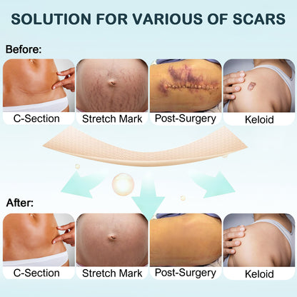 12 pcs Silicone Scar Patch 12 PCS , Silicone Scar Sheet for Stretch Mark, C section Scars Recovery (5.7"X1.5" Size /PC)